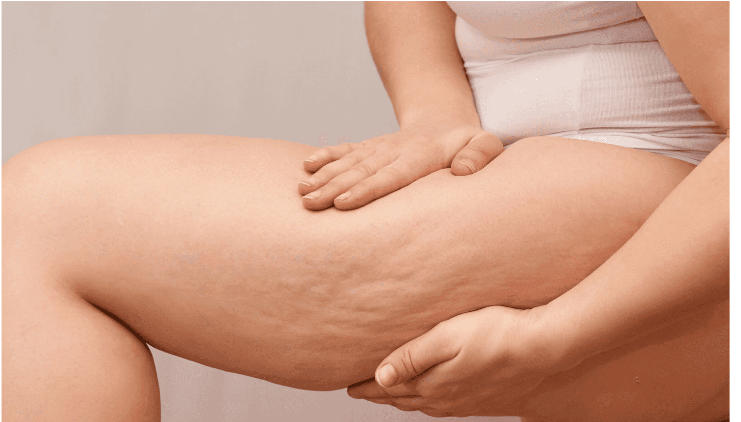 What is Cellulite and What Can You Do About It? 1 Screen Shot 2022 08 05 at 1.30.28 PM 1