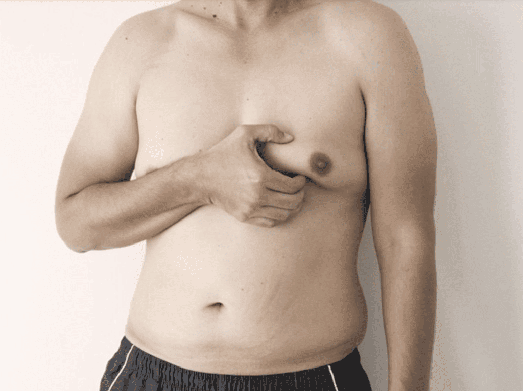 Gynecomastia in a Male