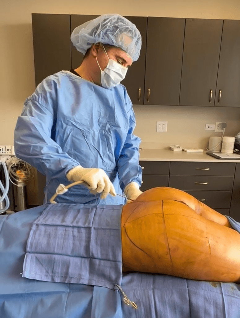 Awake BBL BodyLuxe Chicago Plastic Surgeon