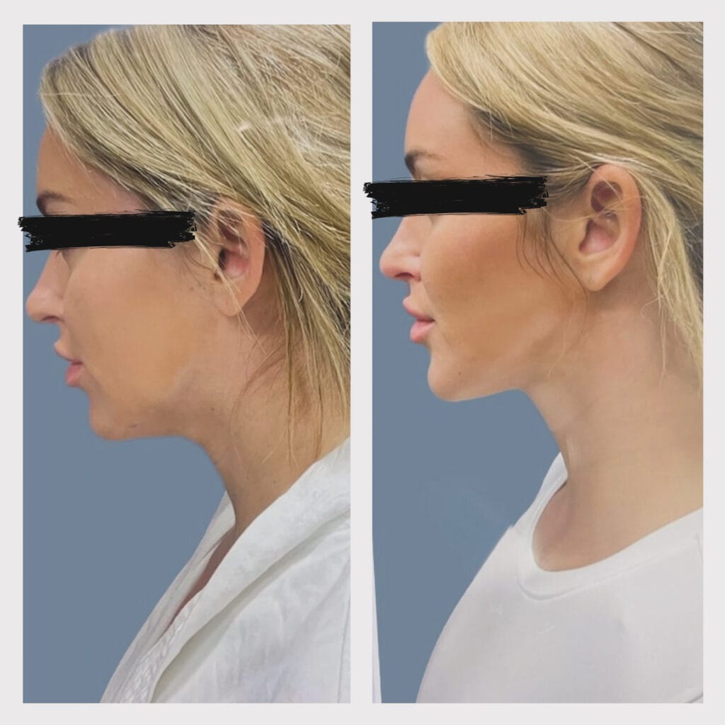 Liposuction vs. Kybella in Chicago: Remove Chin Fat Safely With This Alternative 19 AB2EB478 CA4F 4324 89E7 66A9A2AF1282