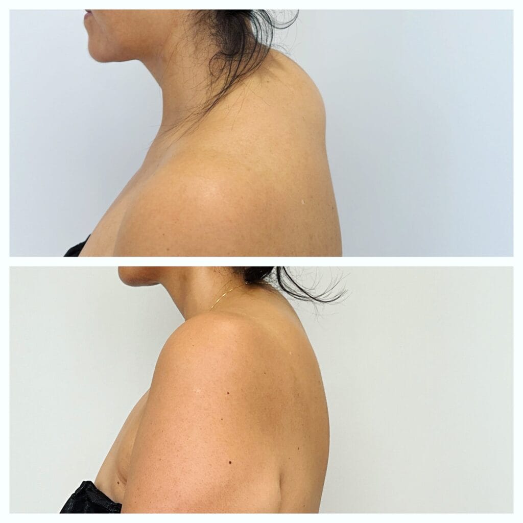 Buffalo Hump Removal in Chicago: Why FormSculpt® Liposuction Is the One‑and‑Done Fix 5 Buffalo hump removal by FormSculpt liposuction in Chicago at BodyLuxe - Before and After Result