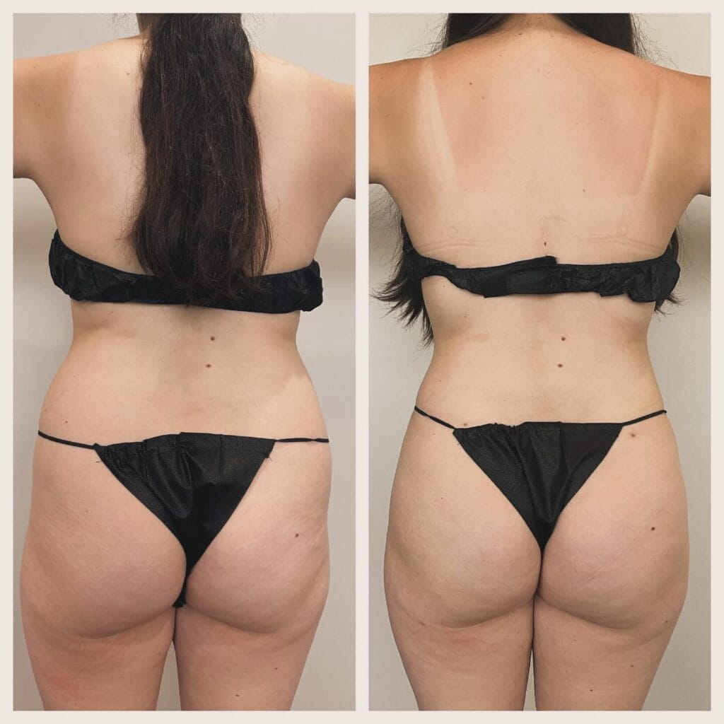 Liposuction vs. GLP-1 Agonists (Ozempic/semaglutide, Mounjaro/tirzepatide, Wegovy, Zepbound and More): Weighing Your Options for Weight Loss and Body Contouring 14 dr.snatched 2024 08 12T163454 2