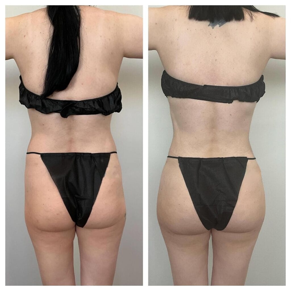 Lymphatic Drainage Massage After Liposuction and BBL Surgery: What You Need to Know in Chicago 48 dr.snatched 2024 11 21T130823 1