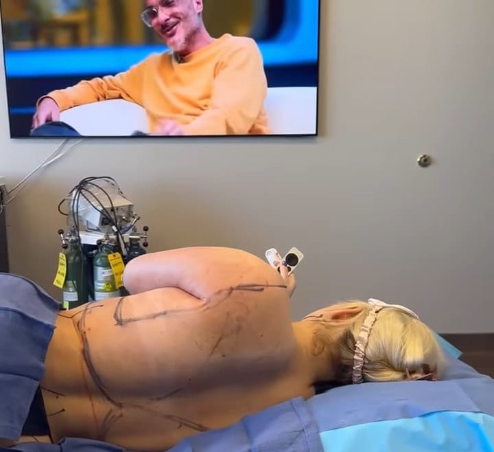 awake-liposuction-chicago-bodyluxe