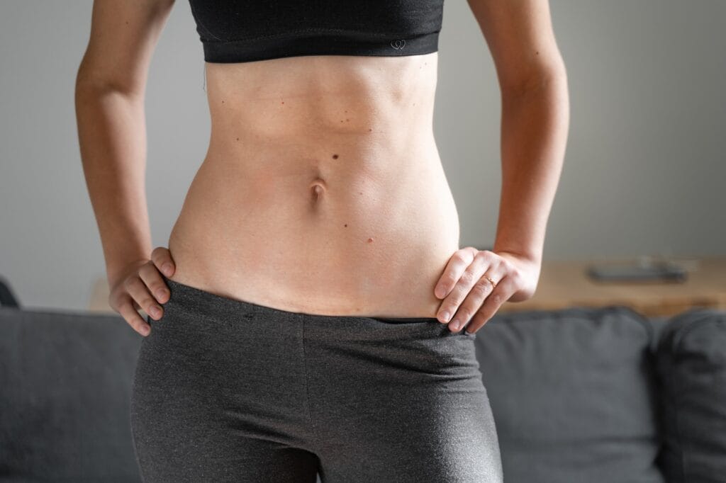 Visceral Fat and Abdominal Liposuction: What You Need to Know 12 Cesarean scar