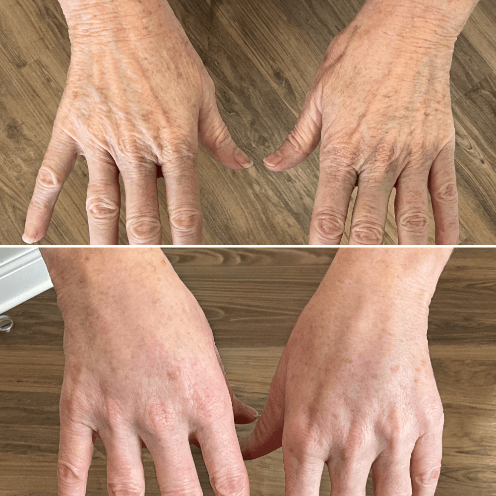 Surgical Procedures in Chicago 3 Before-and-after photographs of a BodyLuxe patient’s hands following hand fat transfer.