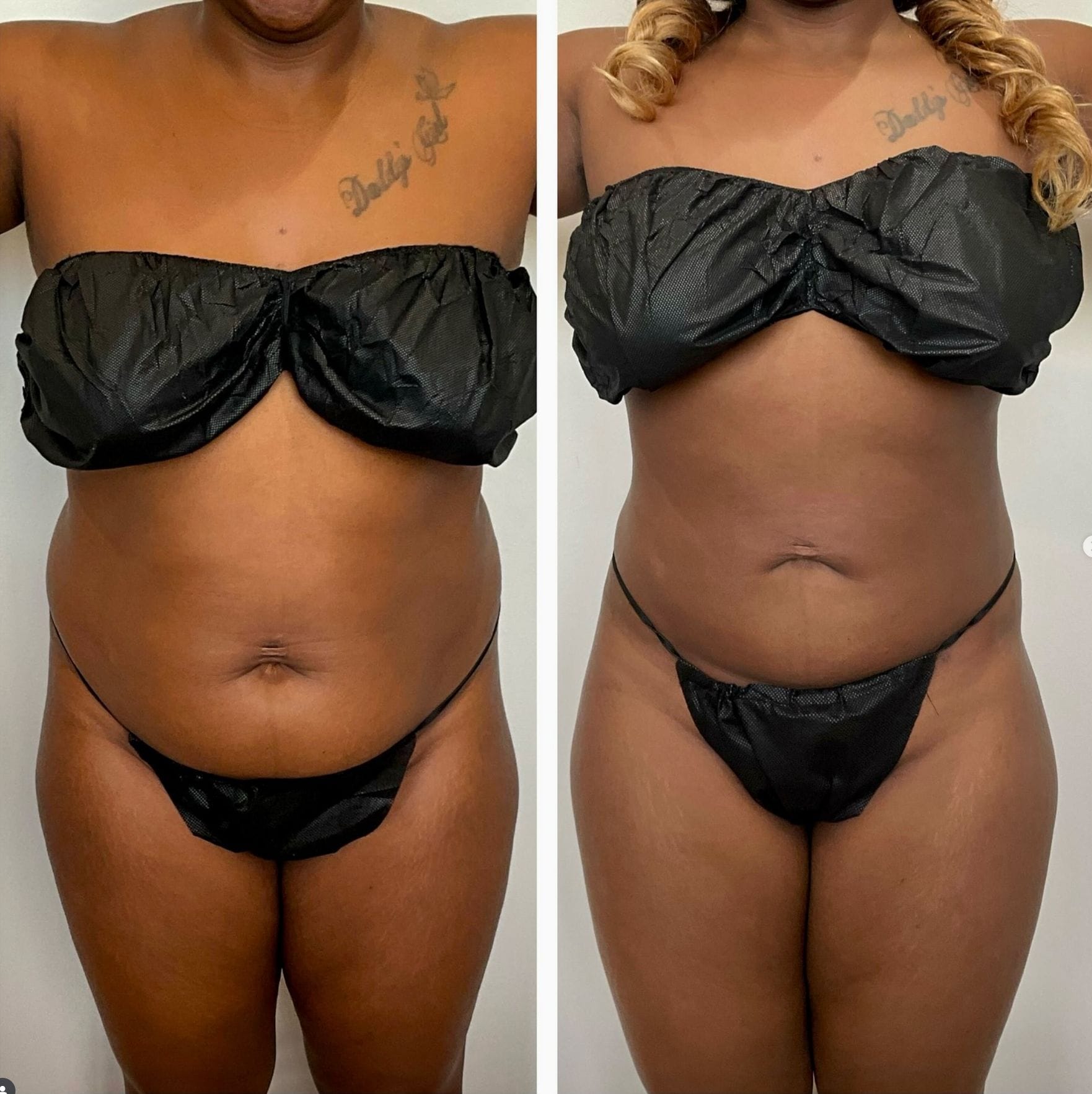 FormSculpt® Awake Liposuction in Chicago 2 Front-view before-and-after collage of an abdomen.