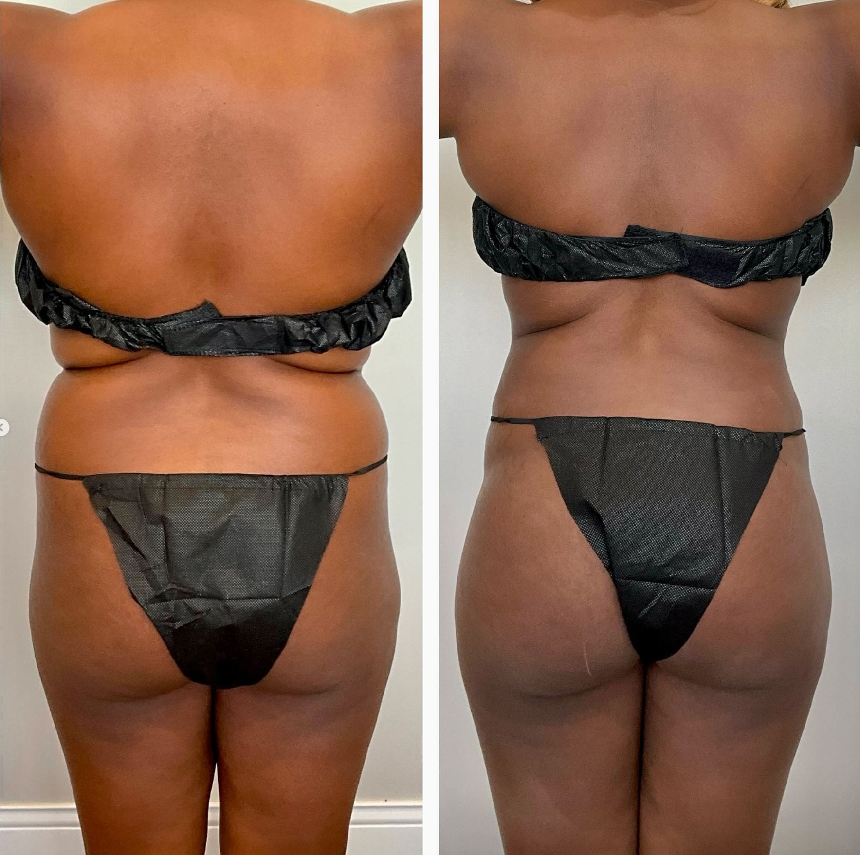 FormSculpt® Awake Liposuction in Chicago 3 Back-view before-and-after collage of an abdomen.
