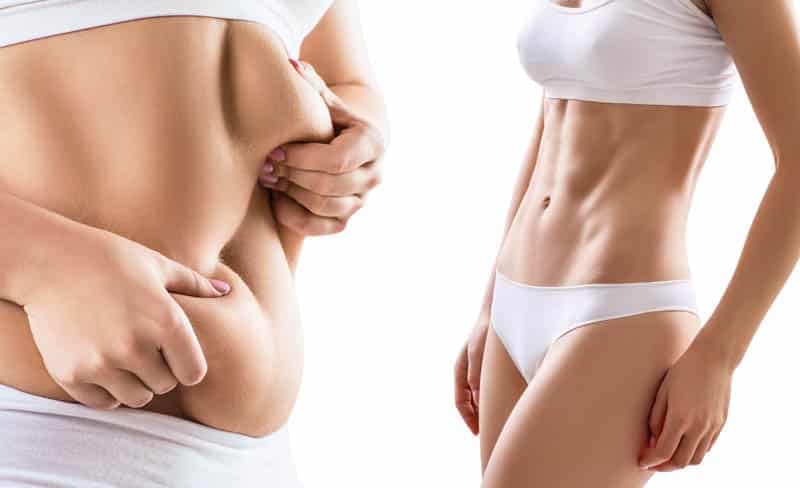 Understanding Weight Loss and Liposuction: Setting Realistic Expectations 26 Understanding Weight Loss and Liposuction: Setting Realistic Expectations