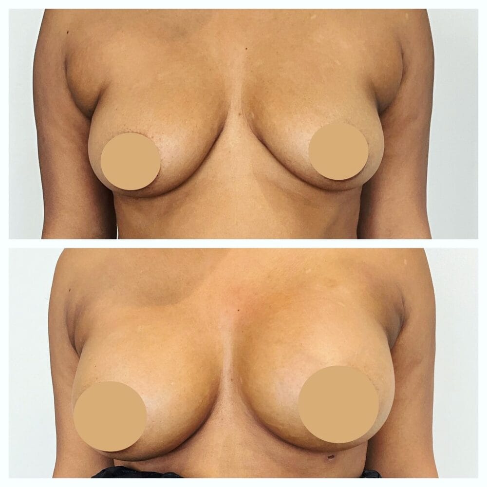 Before and after front view after FormSculpt