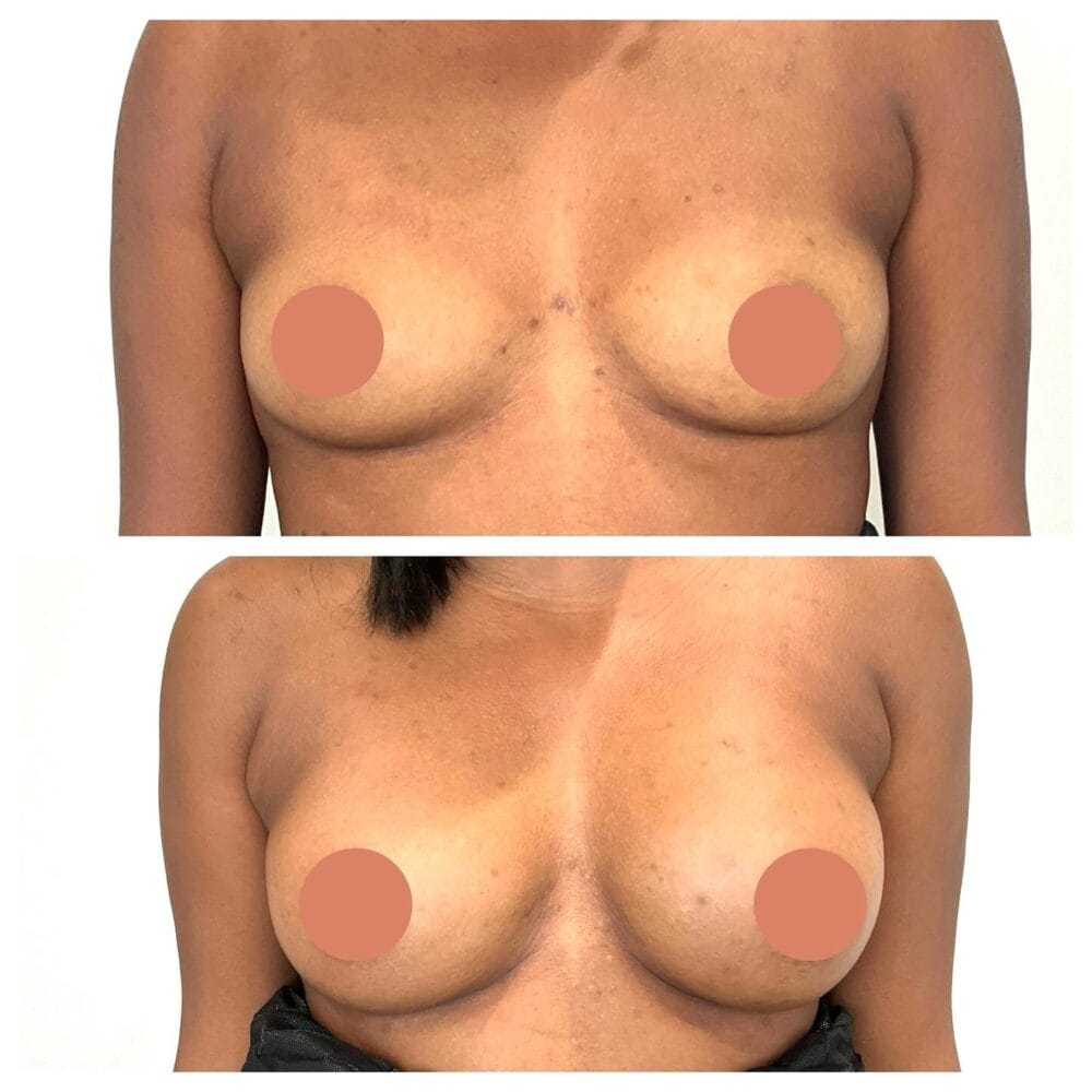 Before and after front view after FormSculpt