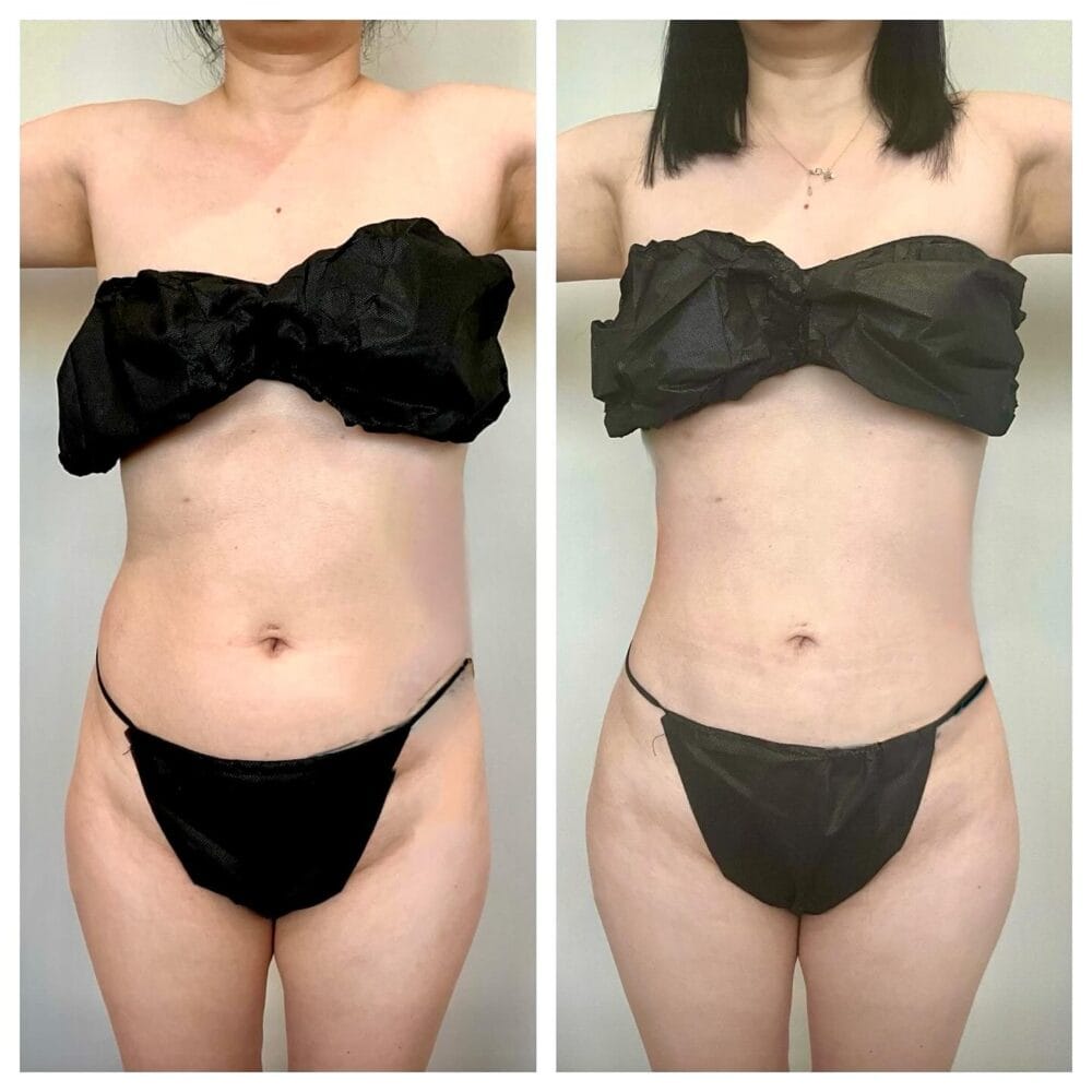 Before and after back view after FormSculpt
