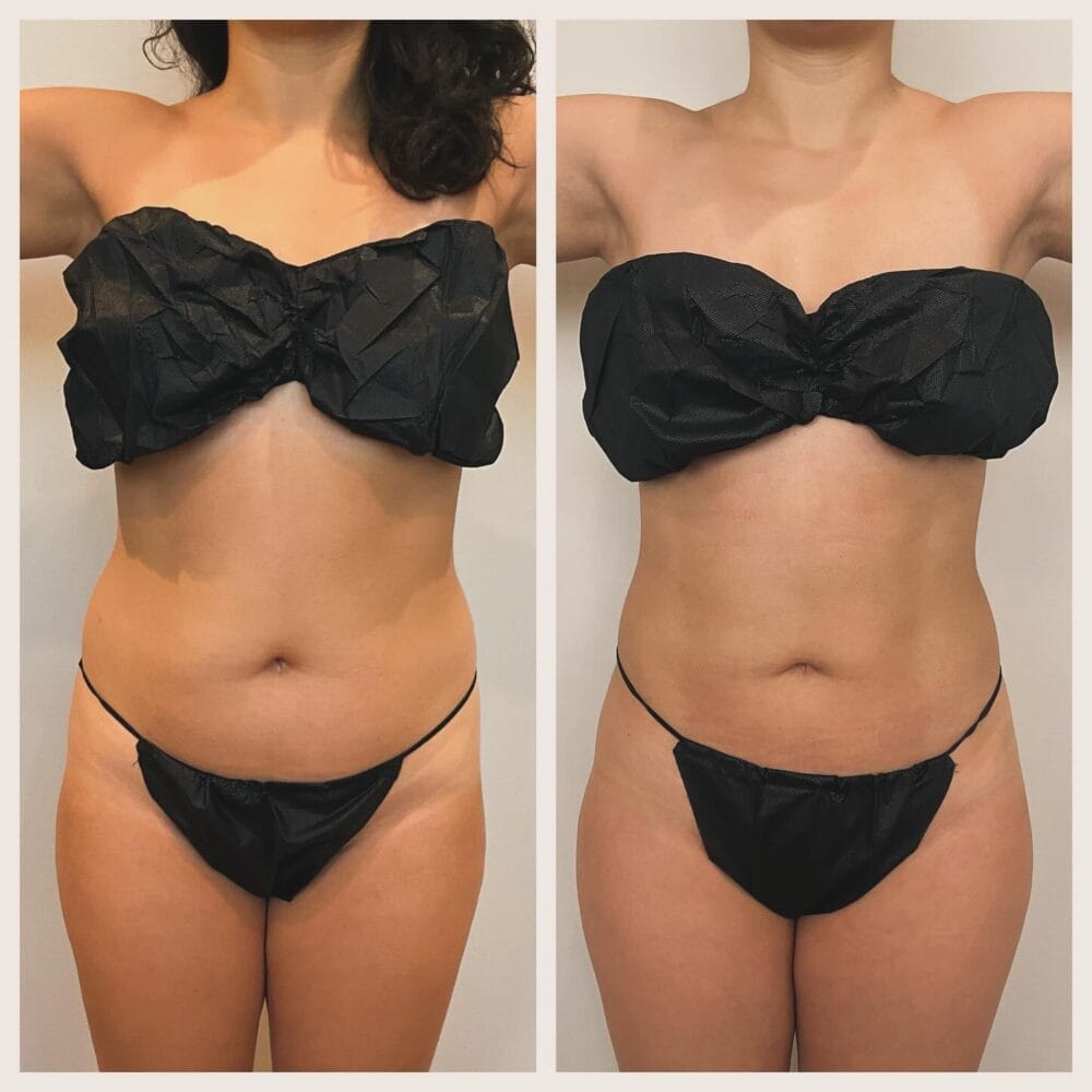 Before and after front view after FormSculpt