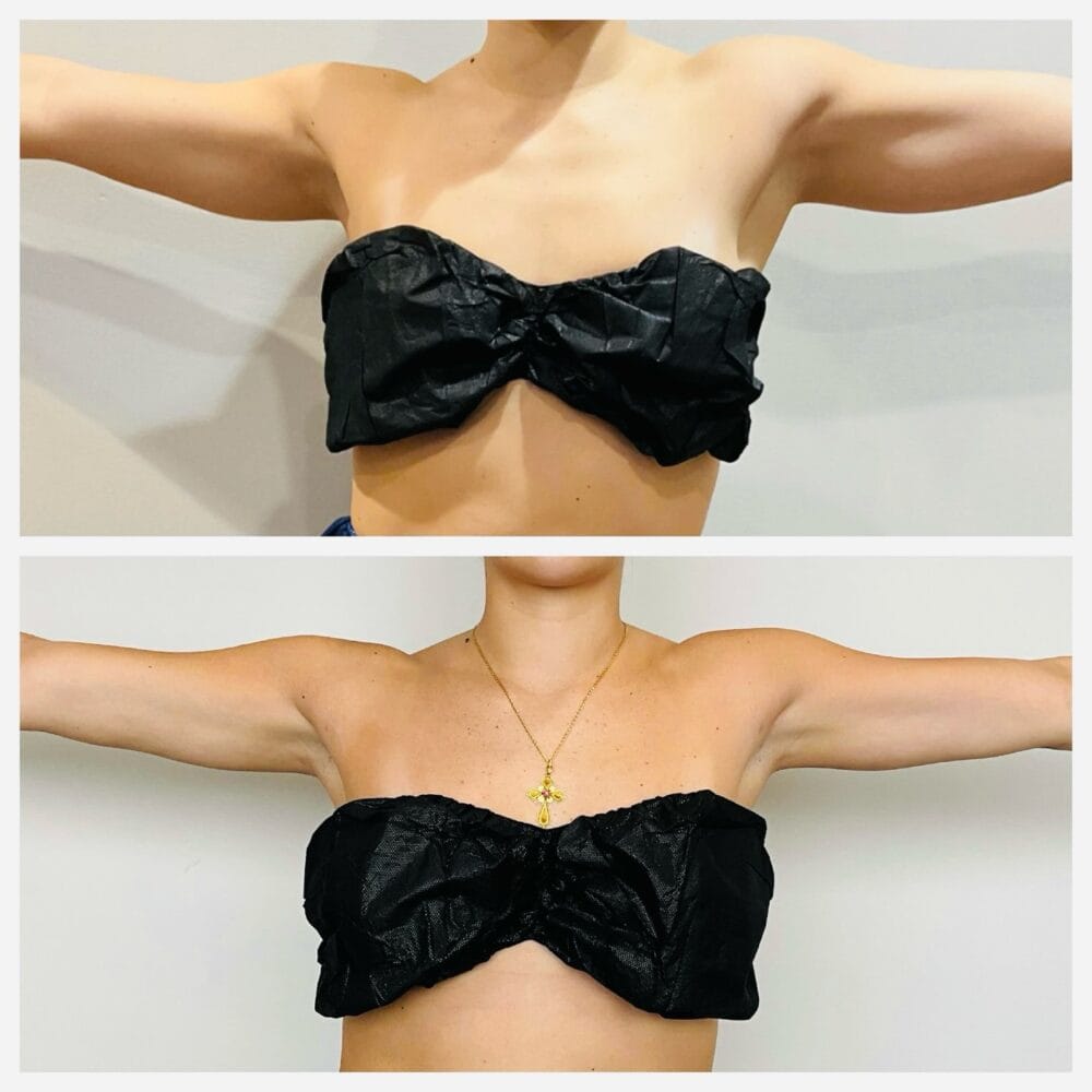 Before and after back view